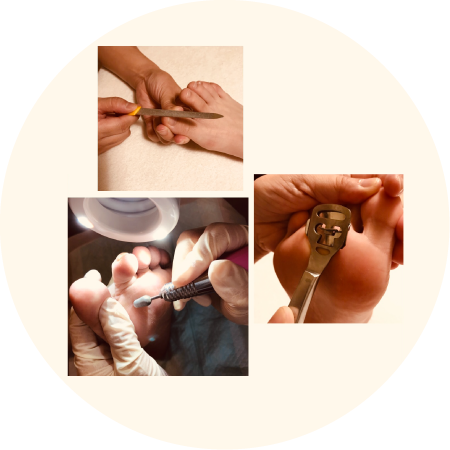 変形爪、たこ・うおのめ、角質ケア