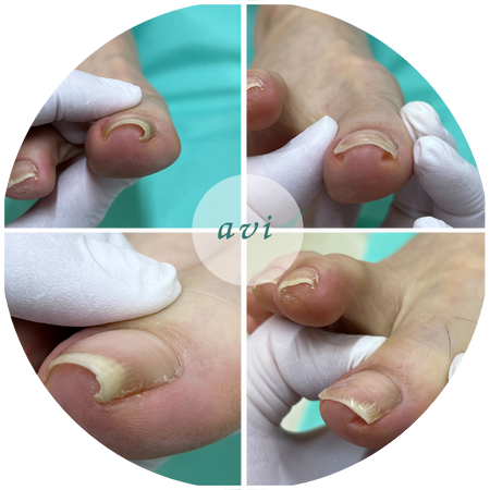 2023年導入最新型巻き爪補正法